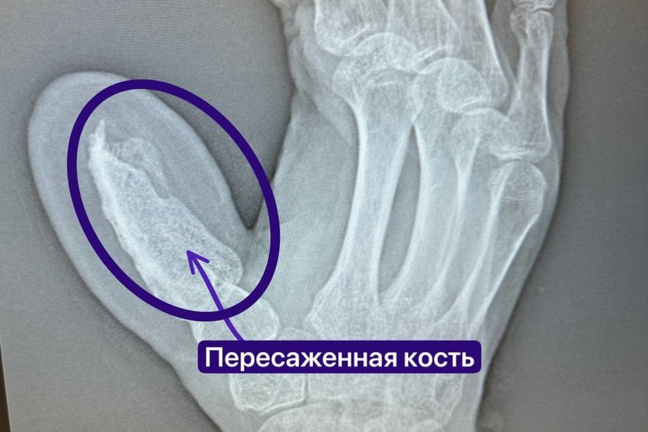 Татарстанские медики провели уникальную пересадку пальца