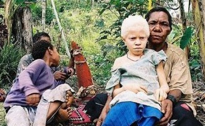 ООН сообщила о росте количества убийств людей с альбинизмом из-за пандемии